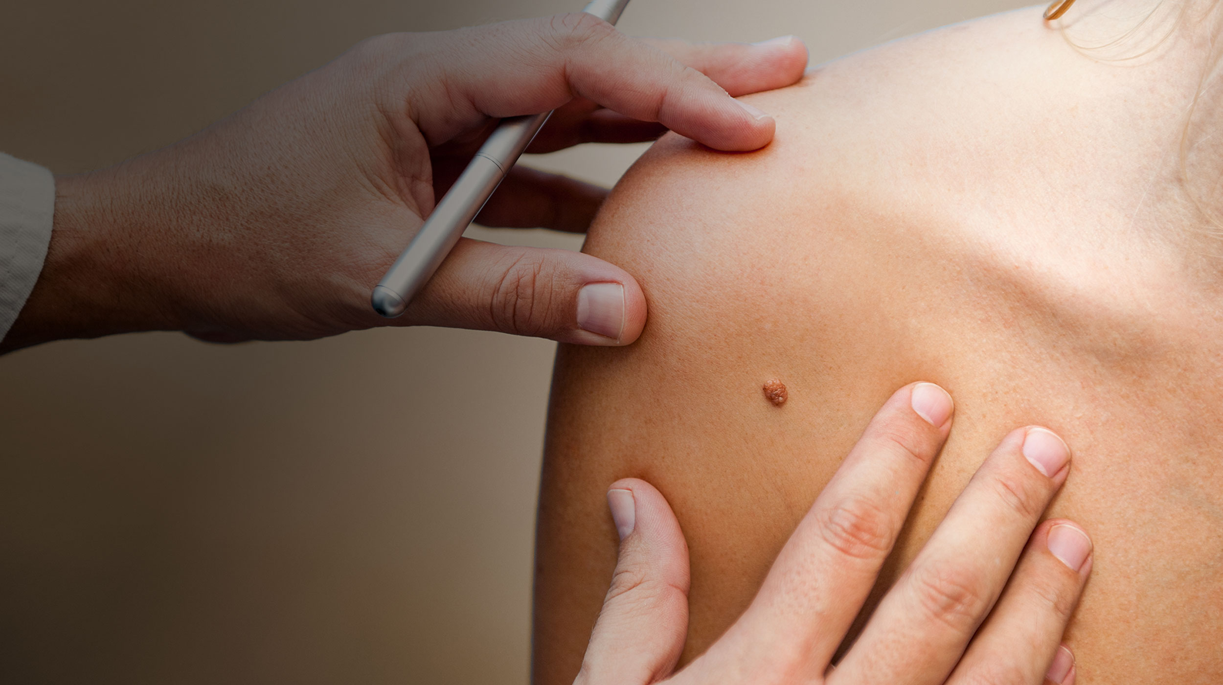 Doctor examining a mole on a patient's skin