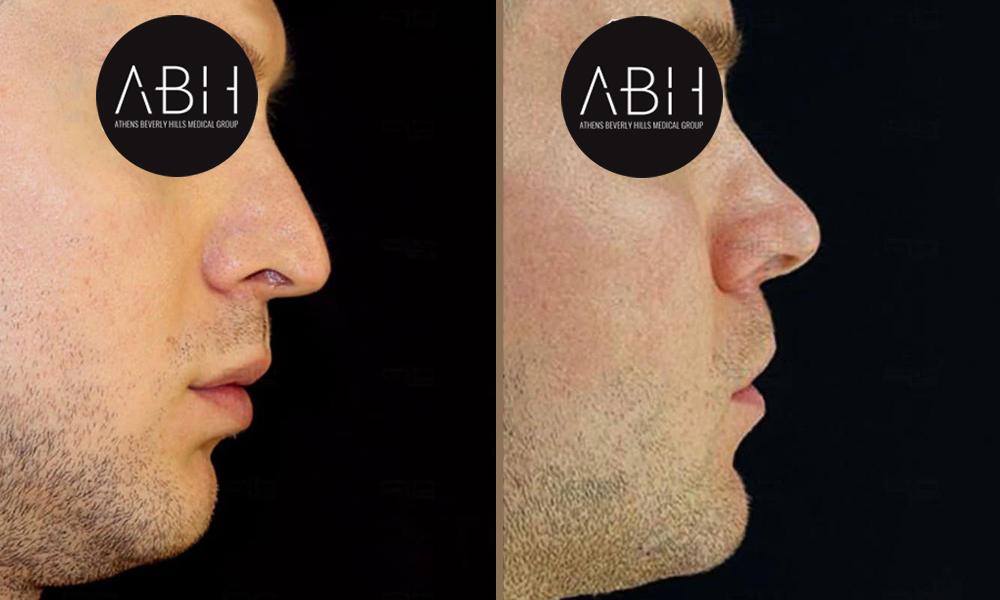 abh-genioplastiki.jpg