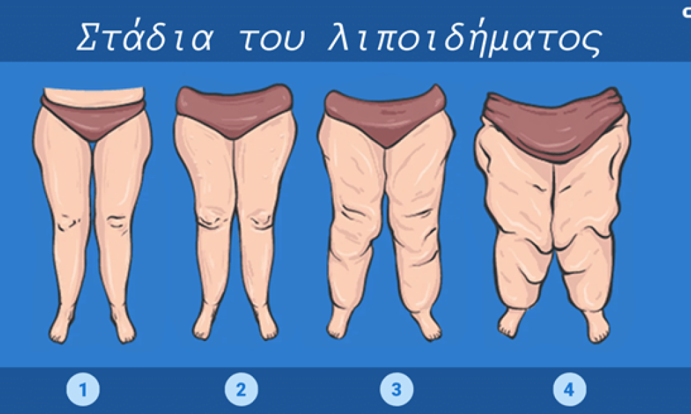 ABH lipedema