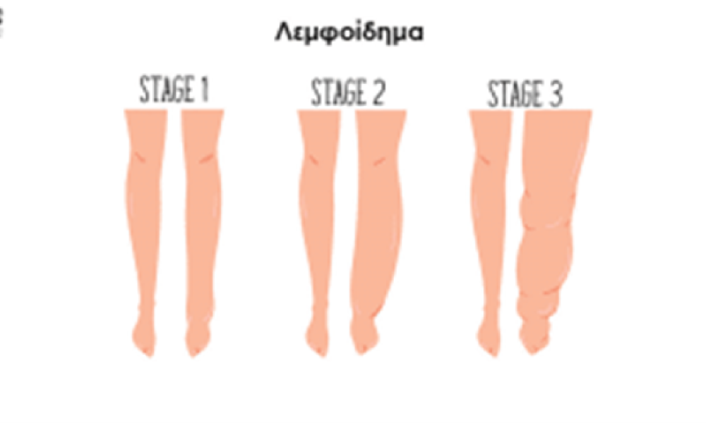 ABH lipedema