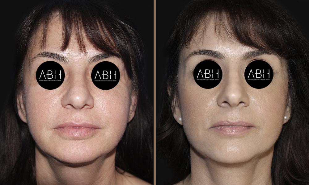 face-lift_001