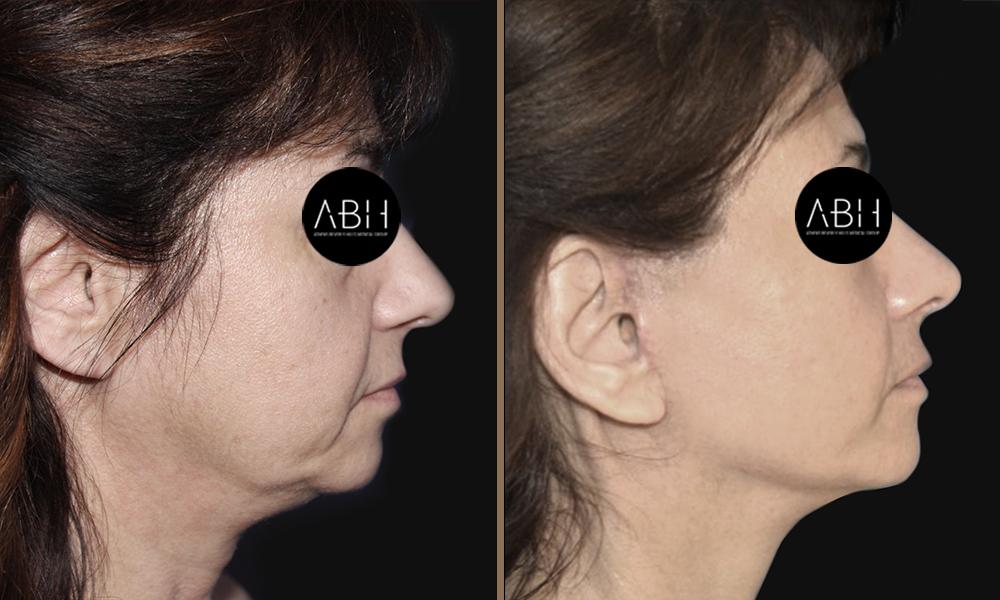 face-lift_002