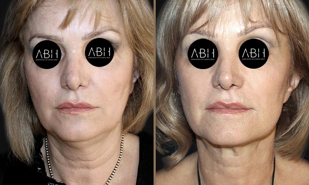 face-lift_003