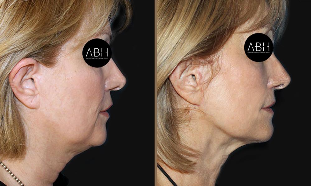face-lift_004