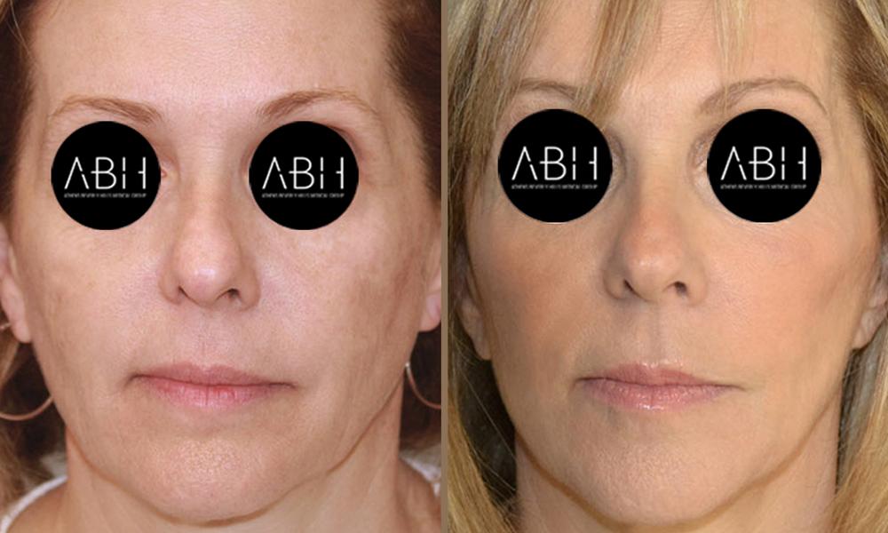 face-lift_005