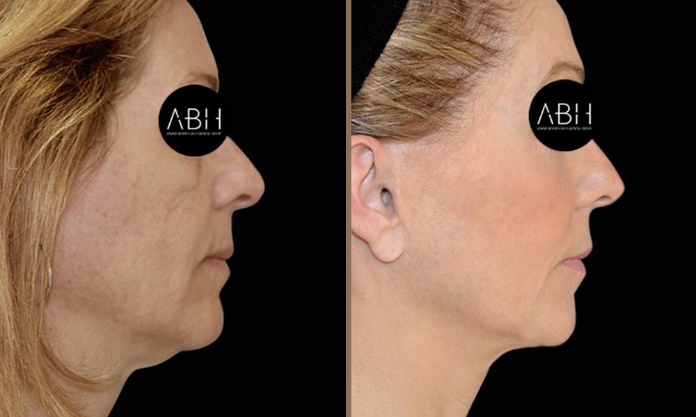 face-lift_006