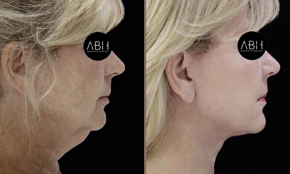 face-lift_008