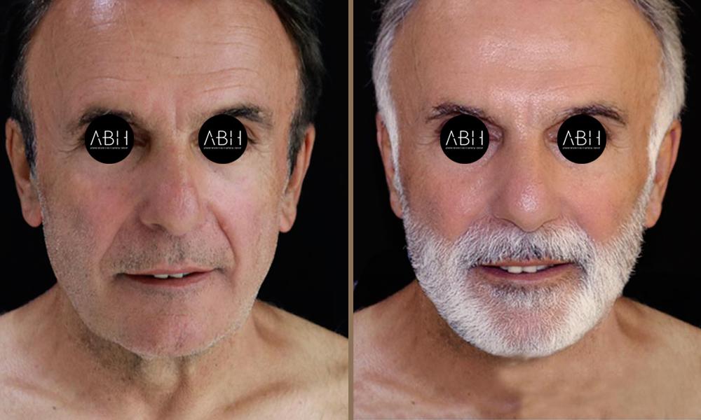 face-lift_013