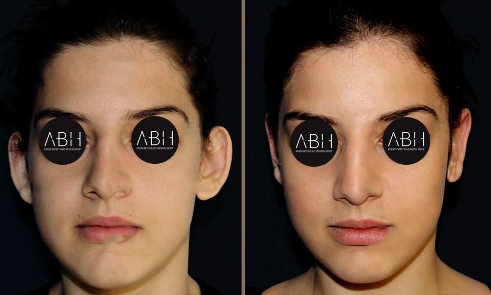 otoplasty-001