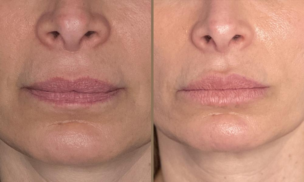 3D LIPS 1