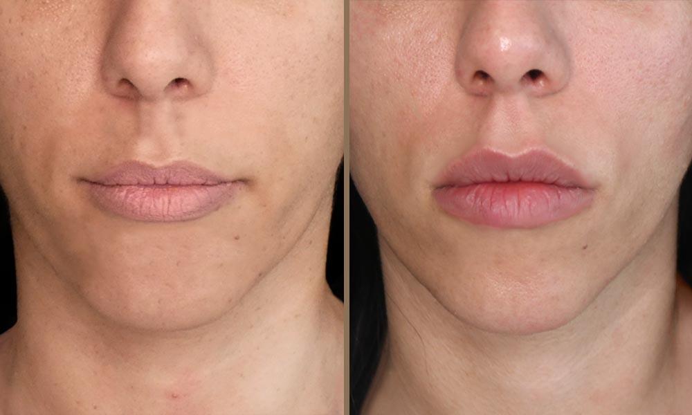 3D LIPS 2