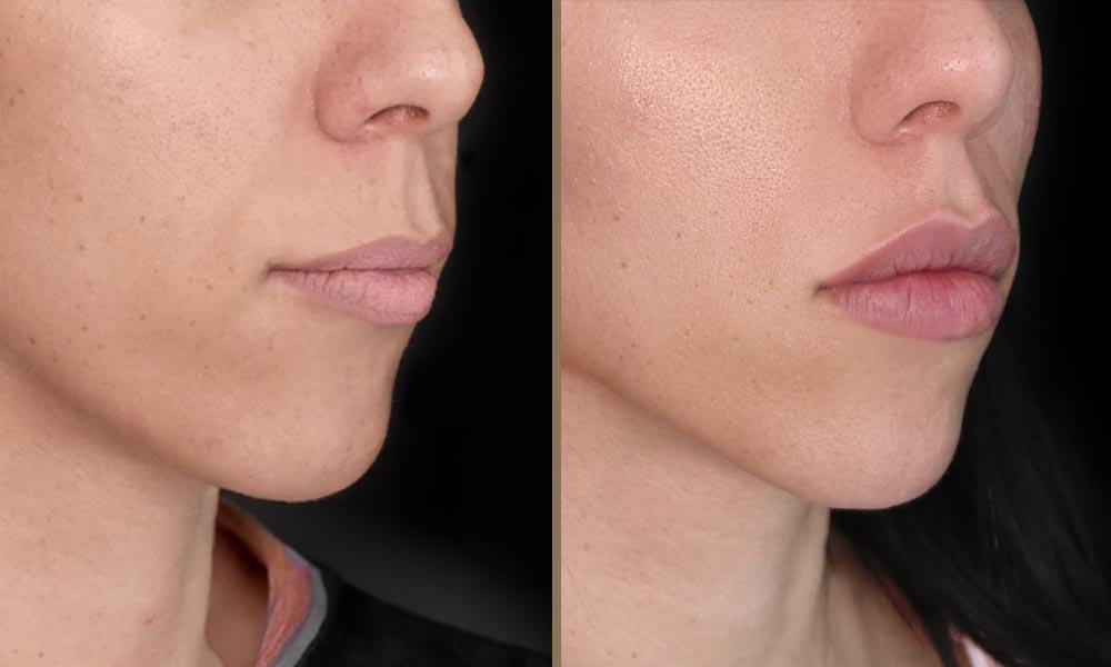 3D LIPS 3