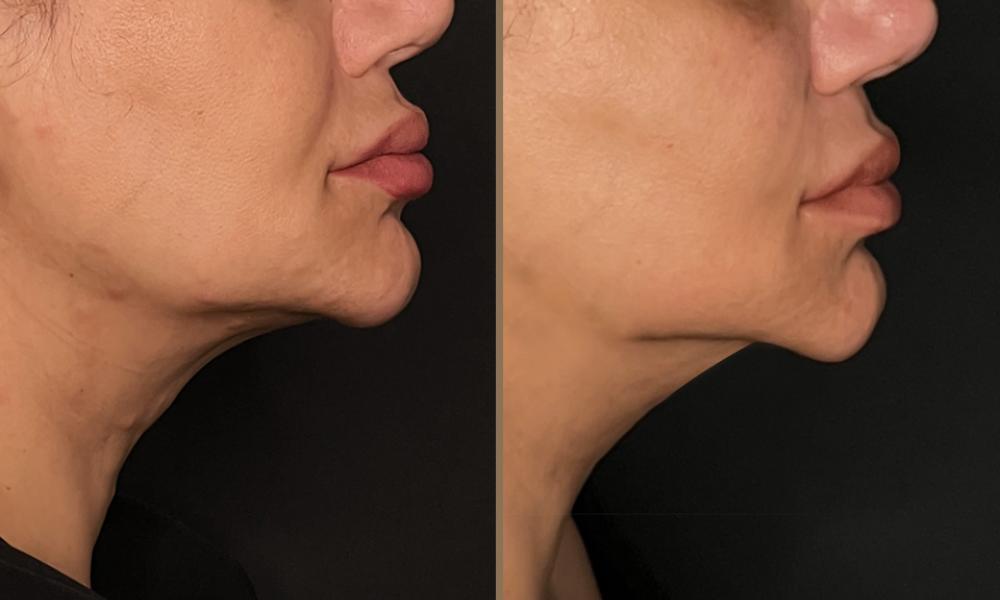 thermage-neck C