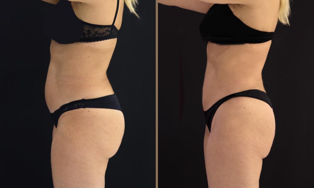 vaser-lipo-andritsopoulou-marilena-c