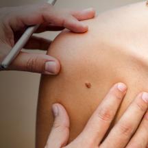 Doctor examining a mole on a patient's skin