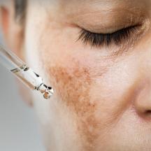 Close-up of a woman's face receiving a serum treatment