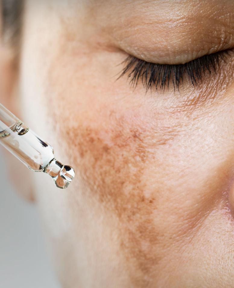 Close-up of a woman's face receiving a serum treatment