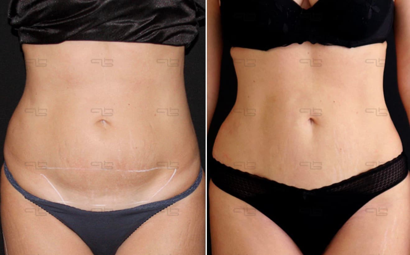 Pearls of Wisdom: Abdominal, Waist and Back Lipo Incisions - Avellanet  Surgical Aesthetics