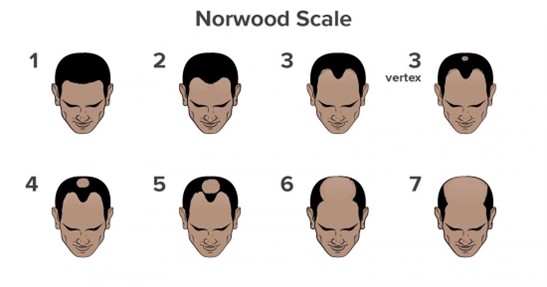 norwood scale