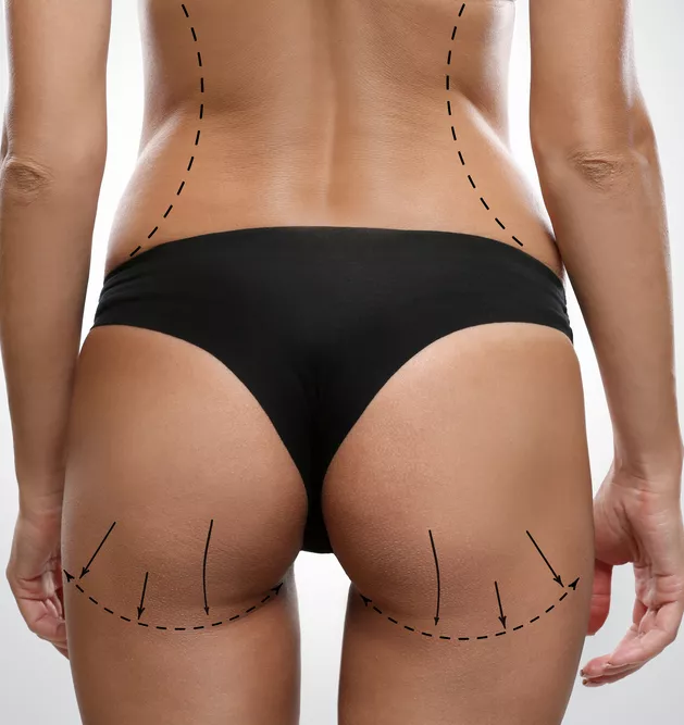 Αυξητική Γλουτών