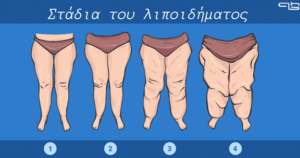 λιποίδημα