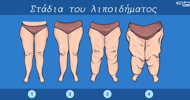 λιποίδημα