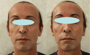 Σύσφιξη και αναδόμηση επιδερμίδας με peeling νέας γενιάς