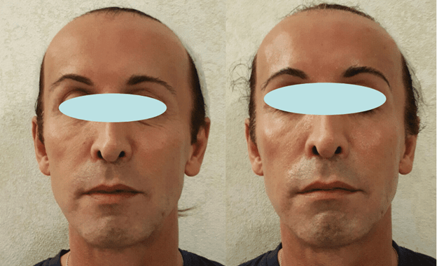 Σύσφιξη και αναδόμηση επιδερμίδας με peeling νέας γενιάς