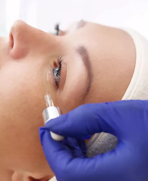 Mesotherapy for Dark Circles