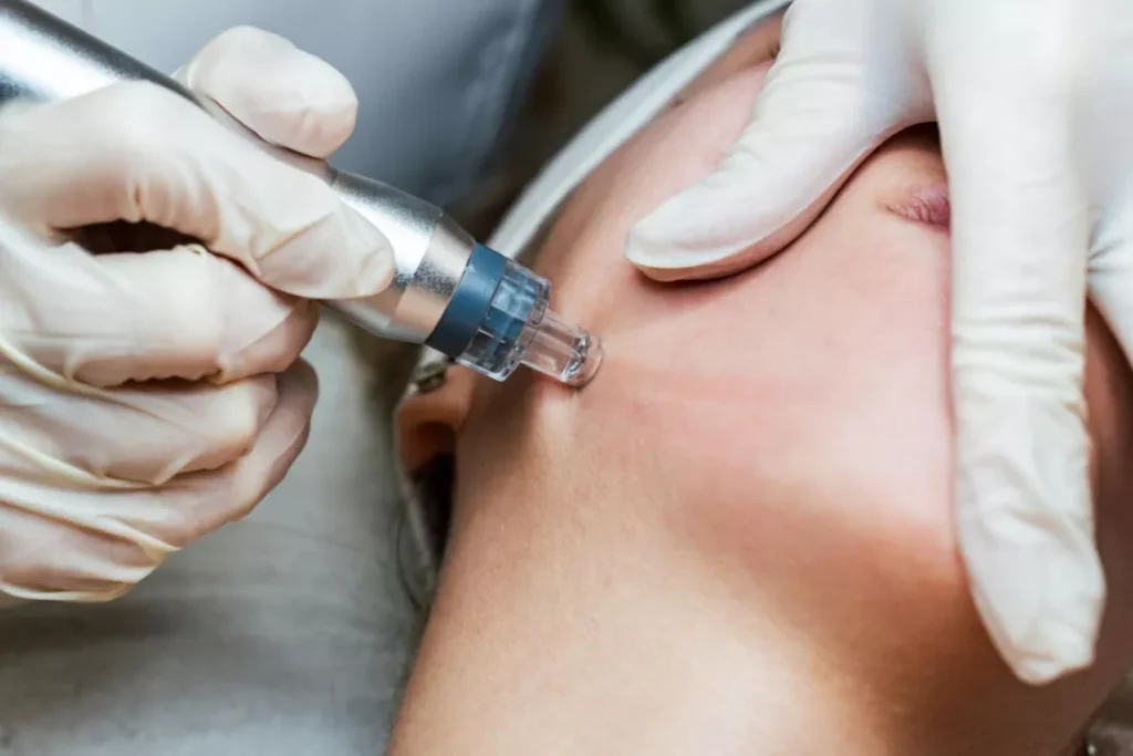 Hydrashine hydradermabrasion Treatment