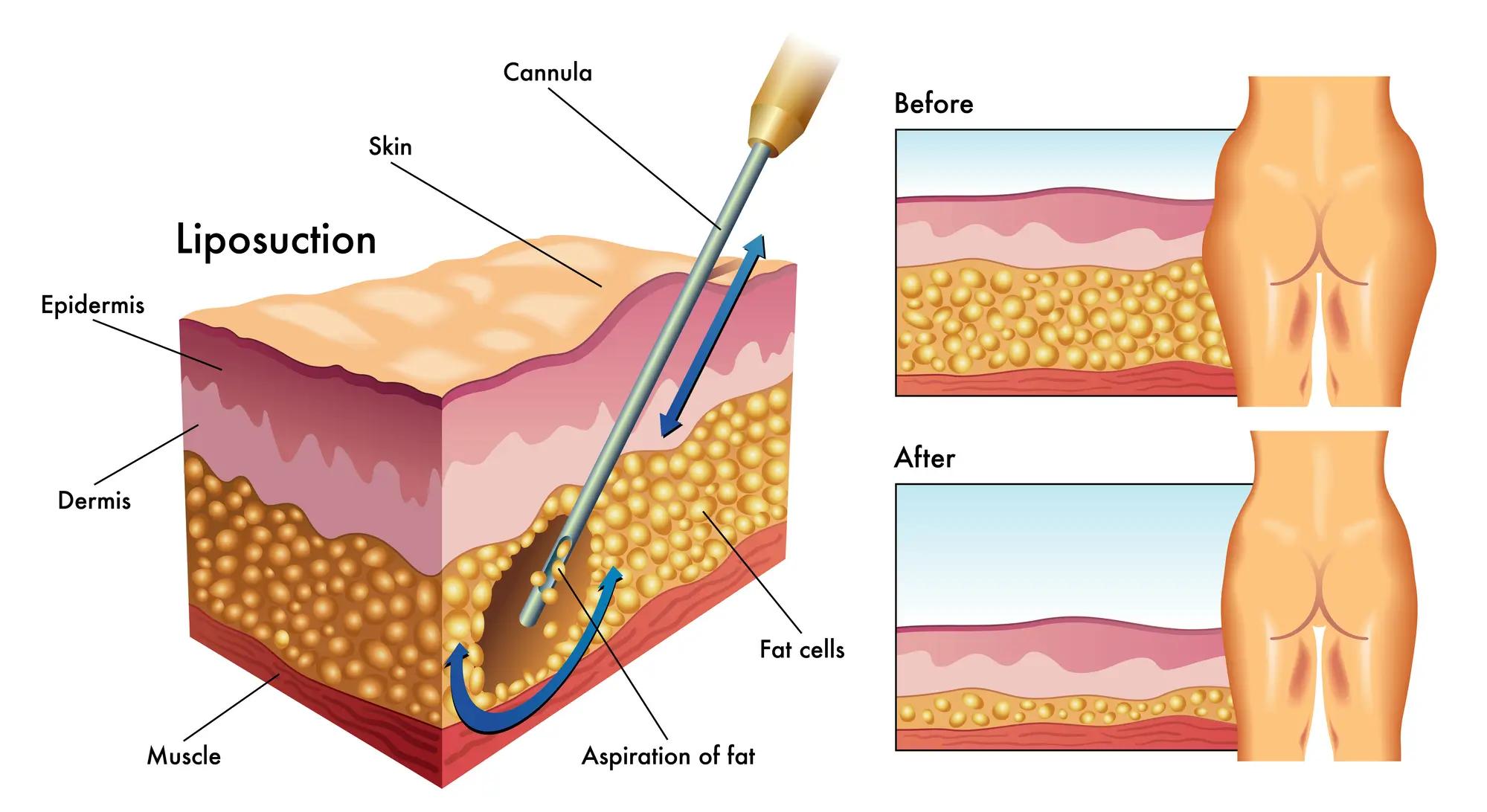 What are the liposuction techniques?