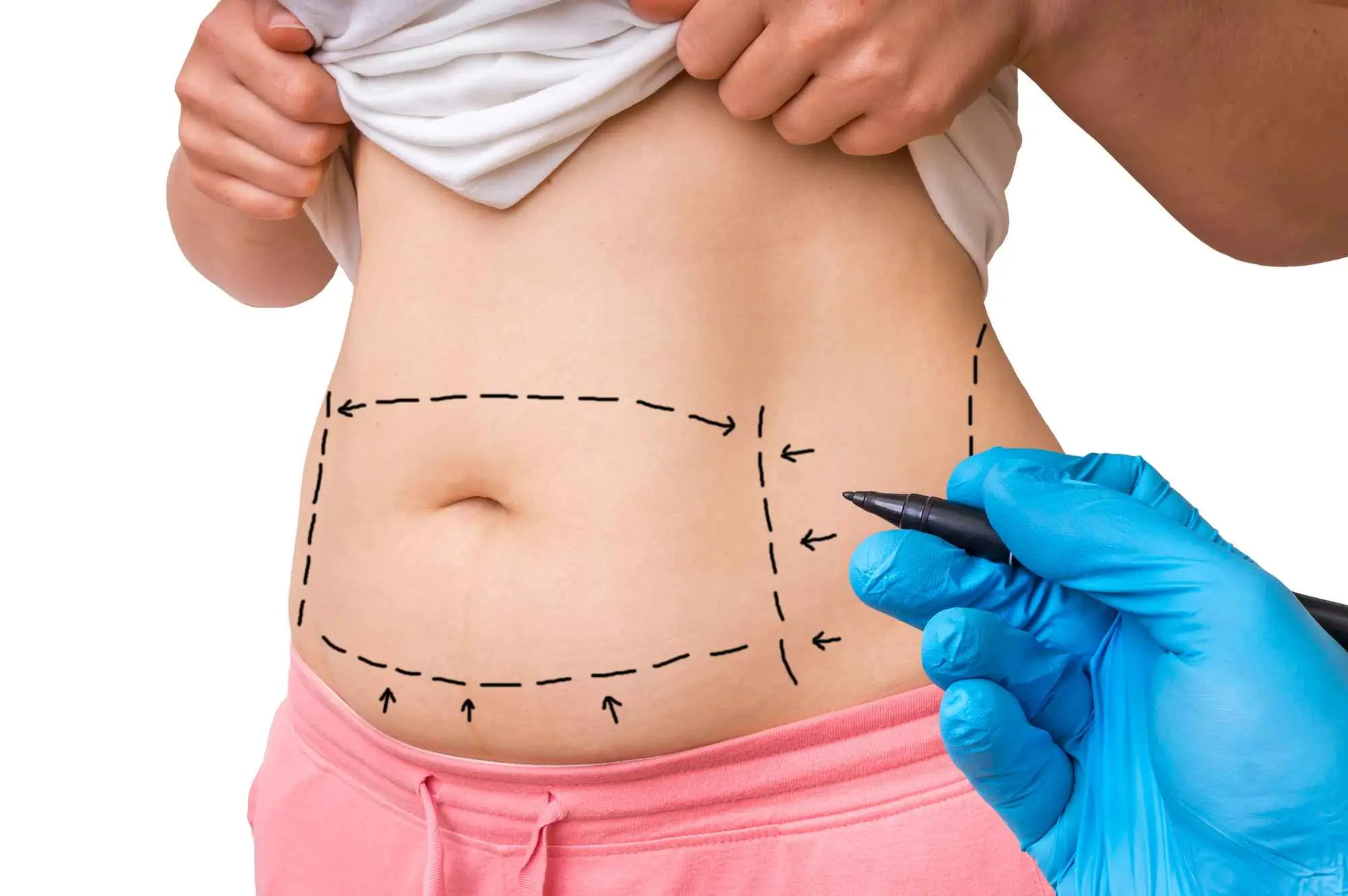How is the liposuction procedure performed?