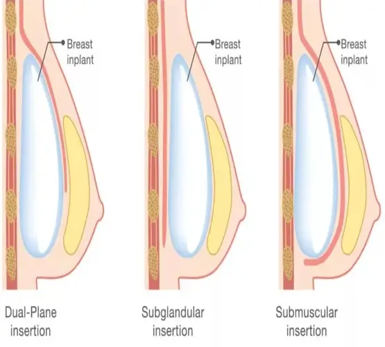 Implant placement techniques